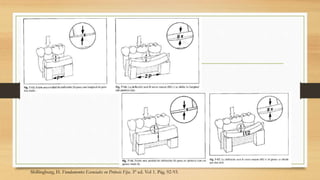 Shillingburg, H. Fundamentos Esenciales en Prótesis Fija. 3° ed. Vol 1. Pág. 92-93.
 