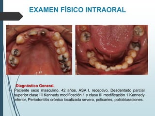 EXAMEN FÍSICO INTRAORAL
Diagnóstico General.
• Paciente sexo masculino, 42 años, ASA I, receptivo. Desdentado parcial
superior clase III Kennedy modificación 1 y clase III modificación 1 Kennedy
inferior, Periodontitis crónica localizada severa, policaries, poliobturaciones.
 