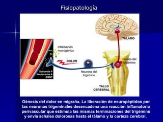 Génesis del dolor en migraña. La liberación de neuropéptidos por las neuronas trigeminales desencadena una reacción inflamatoria perivascular que estimula las mismas terminaciones del trigémino y envía señales dolorosas hasta el tálamo y la corteza cerebral.  Fisiopatología 