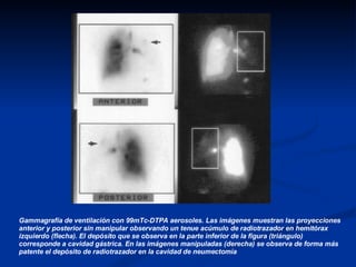 Gammagrafía de ventilación con 99mTc-DTPA aerosoles. Las imágenes muestran las proyecciones anterior y posterior sin manip...