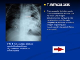 <ul><li>TUBERCULOSIS </li></ul><ul><li>Si se sospecha de tuberculosis pulmonar debemos recordar que no existe una imagen p...