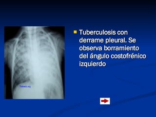 <ul><li>Tuberculosis con derrame pleural. Se observa borramiento del ángulo costofrénico izquierdo </li></ul>
