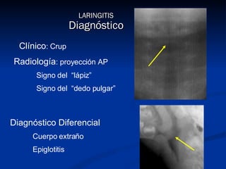LARINGITIS Diagnóstico Clínico : Crup Radiología : proyección AP Signo del  “lápiz” Signo del  “dedo pulgar” Diagnóstico D...