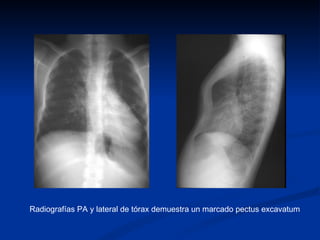 Radiografías PA y lateral de tórax demuestra un marcado pectus excavatum  