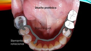 Diseño protésico
Elemento anti
rotacional
Barra lingual
 