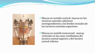 Marcas en sentido vertical: marcas en los
incisivos centrales inferiores
correspondientes a los bordes incisales de
los incisivos centrales superiores.
 Marcas en sentido transversal: marcas
verticales en las caras vestibulares del
incisivo central superior y del incisivo
central inferior.
 