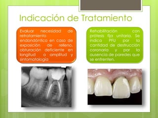 Indicación de Tratamiento
Evaluar necesidad de
retratamiento
endondóntico en caso de
exposición de relleno,
obturación deficiente en
longitud o amplitud y
sintomatología
Rehabilitación con
prótesis fija unitaria. Se
indica PFU por la
cantidad de destrucción
coronaria y por la
ausencia de paredes que
se enfrenten.
 