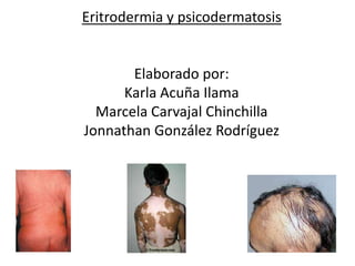 Eritrodermia y psicodermatosis


       Elaborado por:
      Karla Acuña Ilama
  Marcela Carvajal Chinchilla
Jonnathan González Rodríguez
 