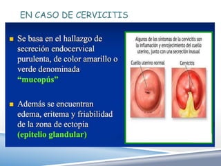 EN CASO DE CERVICITIS
 