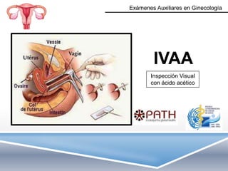 Exámenes Auxiliares en Ginecología




        IVAA
       Inspección Visual
       con ácido acético
 