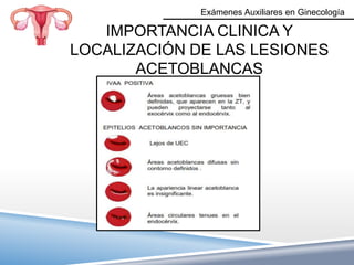 Exámenes Auxiliares en Ginecología

   IMPORTANCIA CLINICA Y
LOCALIZACIÓN DE LAS LESIONES
       ACETOBLANCAS
 