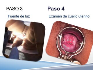 PASO 3
Fuente de luz   Examen de cuello uterino
 
