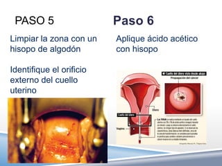 PASO 5
Limpiar la zona con un    Aplique ácido acético
hisopo de algodón         con hisopo

Identifique el orificio
externo del cuello
uterino
 
