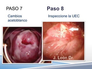 PASO 7
Cambios       Inspeccione la UEC
acetoblanco
 