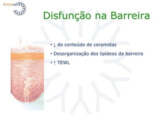 Disfunção na Barreira
• ↓ do conteúdo de ceramidas
• Desorganização dos lipídeos da barreira
• ↑ TEWL
 