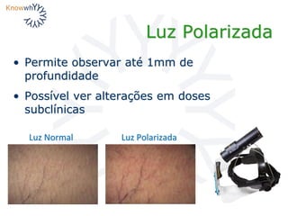 Luz Polarizada
• Permite observar até 1mm de
profundidade
• Possível ver alterações em doses
subclínicas
Luz Normal Luz Polarizada
 