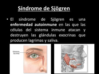 Síndrome de Sjögren
• El síndrome de Sjögren es una
enfermedad autoinmune en las que las
células del sistema inmune atacan y
destruyen las glándulas exocrinas que
producen lagrimas y saliva.
 