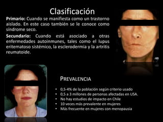 Clasificación
Primario: Cuando se manifiesta como un trastorno
aislado. En este caso también se le conoce como
síndrome seco.
Secundario: Cuando está asociado a otras
enfermedades autoinmunes, tales como el lupus
eritematoso sistémico, la esclerodermia y la artritis
reumatoide.
PREVALENCIA
• 0,5-4% de la población según criterio usado
• 0,5 a 3 millones de personas afectadas en USA.
• No hay estudios de impacto en Chile
• 10 veces más prevalente en mujeres
• Más frecuente en mujeres con menopausia
 