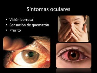 Síntomas oculares
• Visión borrosa
• Sensación de quemazón
• Prurito
 