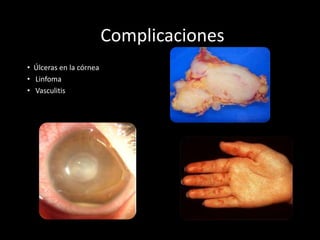 Complicaciones
• Úlceras en la córnea
• Linfoma
• Vasculitis
 