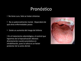 Pronóstico
• No tiene cura. Solo se tratan síntomas
• No es potencialmente mortal. Dependerá de
qué otras enfermedades posea
• Existe un aumento del riesgo de linfoma
• En el tratamiento odontológico, el control que
logremos de la hiposalivación afectará
directamente nuestro pronóstico en
rehabilitación, pues la saliva es un factor
protector de la caries dental.
 