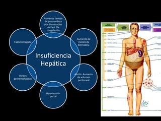 Insuficiencia
Hepática
Aumento tiempo
de protrombina
por disminución
de Fact. De
coagulación
Aumento de
niveles de
bilirrubina
Ascitis: Aumento
de volumen
peritoneal
Hipertensión
portal
Várices
gastroesofágicas
Esplenomegalia
 