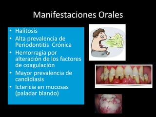 Manifestaciones Orales
• Halitosis
• Alta prevalencia de
Periodontitis Crónica
• Hemorragia por
alteración de los factores
de coagulación
• Mayor prevalencia de
candidiasis
• Ictericia en mucosas
(paladar blando)
 