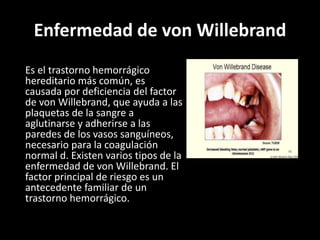 Enfermedad de von Willebrand
Es el trastorno hemorrágico
hereditario más común, es
causada por deficiencia del factor
de von Willebrand, que ayuda a las
plaquetas de la sangre a
aglutinarse y adherirse a las
paredes de los vasos sanguíneos,
necesario para la coagulación
normal d. Existen varios tipos de la
enfermedad de von Willebrand. El
factor principal de riesgo es un
antecedente familiar de un
trastorno hemorrágico.
 