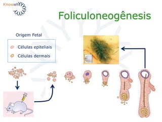 Foliculoneogênesis
Células epiteliais
Células dermais
Origem Fetal
 