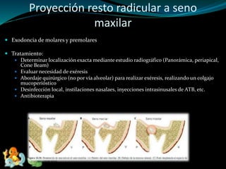 Proyección resto radicular a seno
maxilar
 Exodoncia de molares y premolares
 Tratamiento:
 Determinar localización exacta mediante estudio radiográfico (Panorámica, periapical,
Cone Beam)
 Evaluar necesidad de exéresis
 Abordaje quirúrgico (no por vía alveolar) para realizar exéresis, realizando un colgajo
mucoperióstico
 Desinfección local, instilaciones nasalaes, inyecciones intrasinusales de ATB, etc.
 Antibioterapia
 