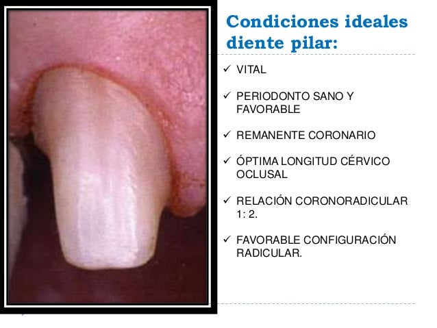Seminario 12 Pilar Prótesis Fija