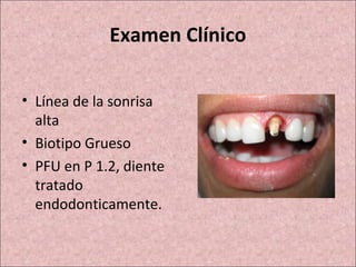Examen Clínico 
• Línea de la sonrisa 
alta 
• Biotipo Grueso 
• PFU en P 1.2, diente 
tratado 
endodonticamente. 
 