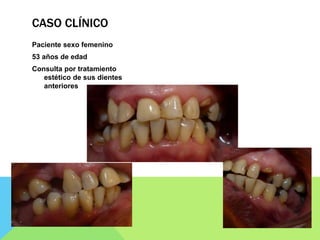 CASO CLÍNICO
Paciente sexo femenino
53 años de edad
Consulta por tratamiento
estético de sus dientes
anteriores
 