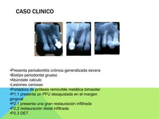 CASO CLINICO
•Presenta periodontitis crónica generalizada severa
•Biotipo periodontal grueso
•Abúndate calculo
•Lesiones c...
