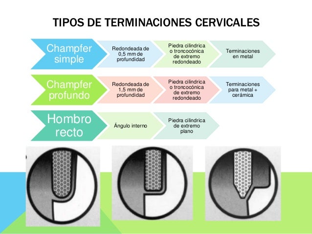 Lineas De Terminacion En Protesis Fija Articulos es.slideshare.net
