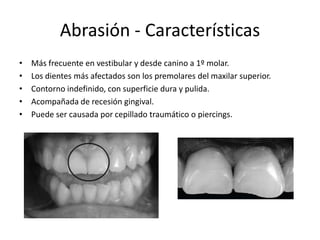 Abrasión - Características
• Más frecuente en vestibular y desde canino a 1º molar.
• Los dientes más afectados son los premolares del maxilar superior.
• Contorno indefinido, con superficie dura y pulida.
• Acompañada de recesión gingival.
• Puede ser causada por cepillado traumático o piercings.
 