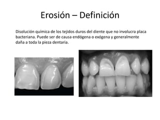 Erosión – Definición
Disolución química de los tejidos duros del diente que no involucra placa
bacteriana. Puede ser de causa endógena o exógena y generalmente
daña a toda la pieza dentaria.
 