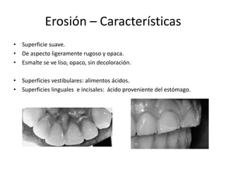 Erosión – Características
• Superficie suave.
• De aspecto ligeramente rugoso y opaca.
• Esmalte se ve liso, opaco, sin decoloración.
• Superficies vestibulares: alimentos ácidos.
• Superficies linguales e incisales: ácido proveniente del estómago.
 
