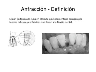 Anfracción - Definición
Lesión en forma de cuña en el límite amelocementario causada por
fuerzas oclusales excéntricas que llevan a la flexión dental.
 