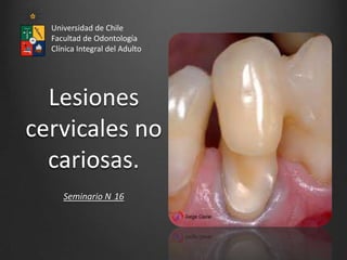 Lesiones
cervicales no
cariosas.
Seminario N 16
Universidad de Chile
Facultad de Odontología
Clínica Integral del Adulto
 