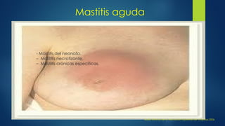 Mastitis aguda
Guías Clínicas de la Asociación Española de Cirujanos 2006
- Mastitis del neonato.
– Mastitis necrotizante.
– Mastitis crónicas específicas.
 