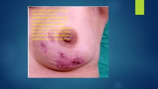 La mastitis granulomatosa
idiopática es una
enfermedad inflamatoria
benigna, infrecuente, de
etiología desconocida.
Habitualmente es unilateral,
pero en raros casos puede
ser bilateral o desarrollarse a
posteriori en la otra mama..
 