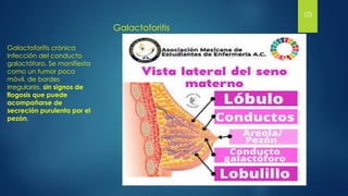 Galactoforitis crónica
Infección del conducto
galactóforo. Se manifiesta
como un tumor poco
móvil, de bordes
irregulares, sin signos de
flogosis que puede
acompañarse de
secreción purulenta por el
pezón.
Galactoforitis
03
 