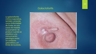 Galactoforitis
03
La galactoforitis
crónica supurativa,
también conocida
como Enfermedad
de Zuska, es una
causa de mastitis
no puerperal. Se
produce cuando se
establece una
comunicación
patológica entre
un conducto
galactóforo y el
límite de la areola.
 