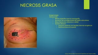 NECROSIS GRASA
Guías Clínicas de la Asociación Española de Cirujanos 2006,
Imagenología
•Ultrasonido:
• Menos específica que la mamografía
• Aumento de la ecogenicidad del tejido subcutáneo
• Masa hipoecoica, anecoica o sólida
• Quistes oleosos:
• Lesiones quísticas con bandas internas ecogénicas
• Calcificaciones en la pared
 