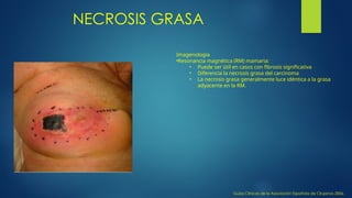 NECROSIS GRASA
Guías Clínicas de la Asociación Española de Cirujanos 2006,
Imagenología
•Resonancia magnética (RM) mamaria:
• Puede ser útil en casos con fibrosis significativa
• Diferencia la necrosis grasa del carcinoma
• La necrosis grasa generalmente luce idéntica a la grasa
adyacente en la RM.
 