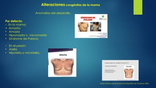 Por defecto:
– En la mama:
• Amastia
• Amazia
• Hipomastia o micromastia
• Síndrome de Poland.
- En el pezón:
• Atelia
• Hipotelia o microtelia.
Anomalías del desarrollo.
Guías Clínicas de la Asociación Española de Cirujanos 2006
Alteraciones congénitas de la mama
 