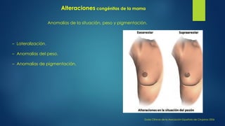 Anomalías de la situación, peso y pigmentación.
– Lateralización.
– Anomalías del peso.
– Anomalías de pigmentación.
Guías Clínicas de la Asociación Española de Cirujanos 2006
Alteraciones congénitas de la mama
 