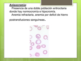 Anisocromía:
Presencia de una doble población eritrocitaria
donde hay normocromía e hipocromía.
Anemia refractaria, anemia por deficit de hierro
postransfusiones sanguíneas.
 