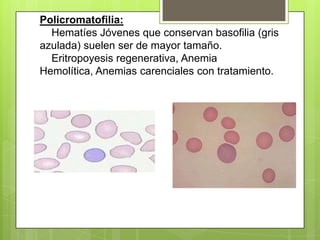Policromatofilia:
Hematíes Jóvenes que conservan basofilia (gris
azulada) suelen ser de mayor tamaño.
Eritropoyesis regenerativa, Anemia
Hemolítica, Anemias carenciales con tratamiento.
 